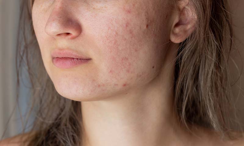 how-to-get-rid-of-blemishes