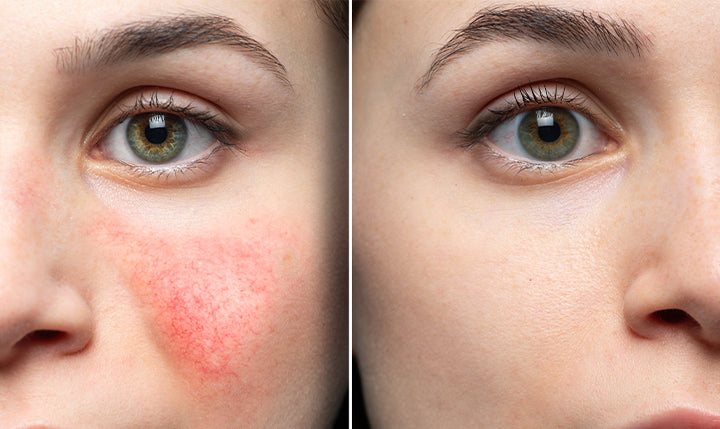 how-to-get-rid-of-rosacea