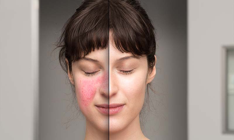 Azelaic Acid for Acne and Rosacea
